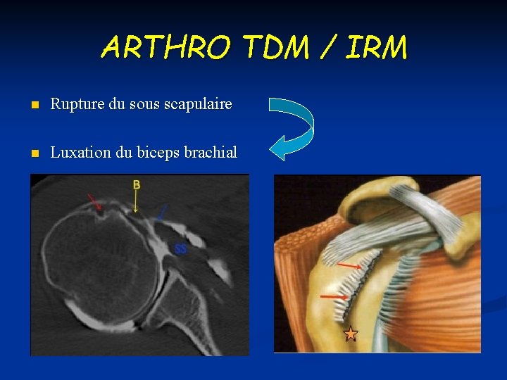 ARTHRO TDM / IRM n Rupture du sous scapulaire n Luxation du biceps brachial