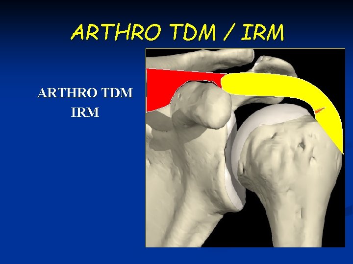 ARTHRO TDM / IRM ARTHRO TDM IRM 