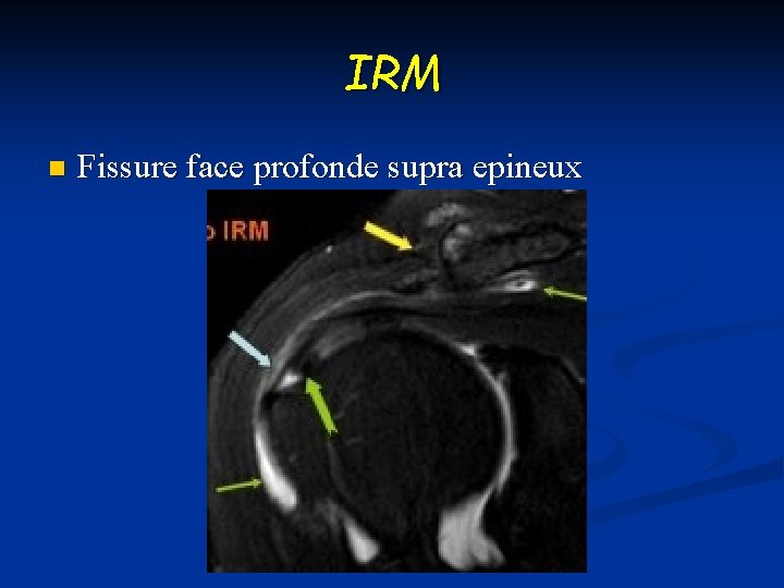 IRM n Fissure face profonde supra epineux 