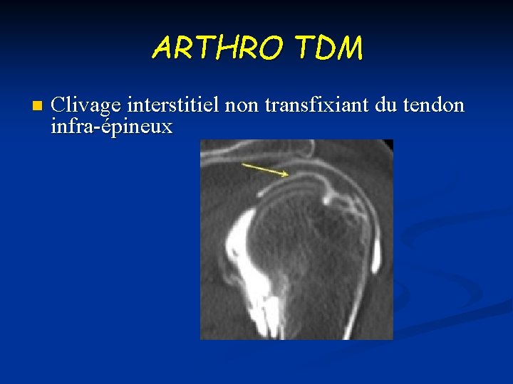 ARTHRO TDM n Clivage interstitiel non transfixiant du tendon infra-épineux 
