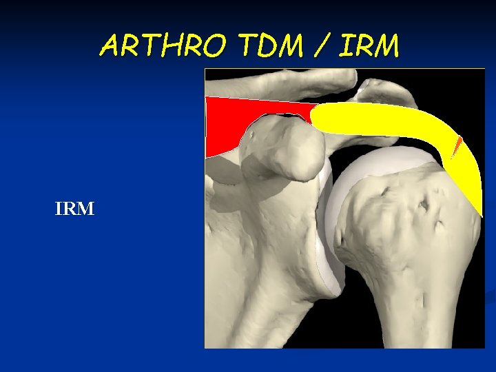 ARTHRO TDM / IRM 