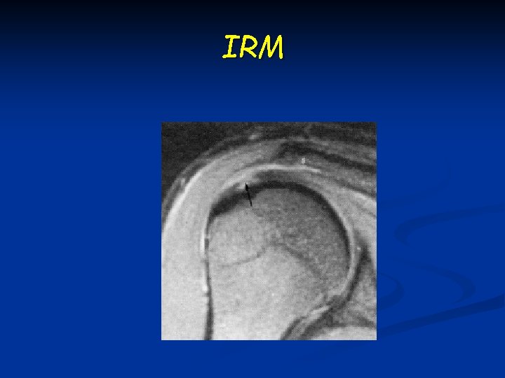 IRM 