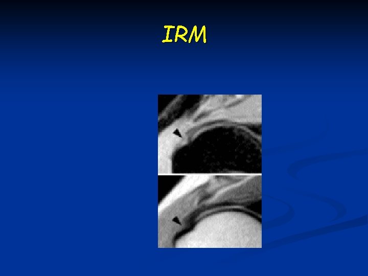 IRM 
