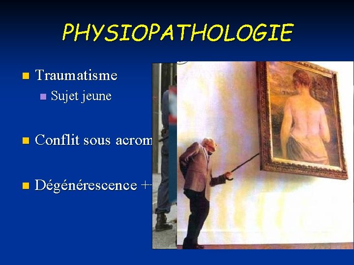 PHYSIOPATHOLOGIE n Traumatisme n Sujet jeune n Conflit sous acromial n Dégénérescence +++ 