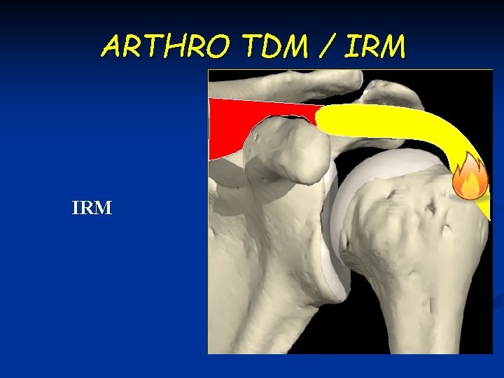 ARTHRO TDM / IRM 