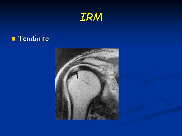 IRM n Tendinite 