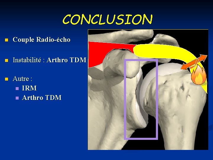 CONCLUSION n Couple Radio-écho n Instabilité : Arthro TDM n Autre : n IRM