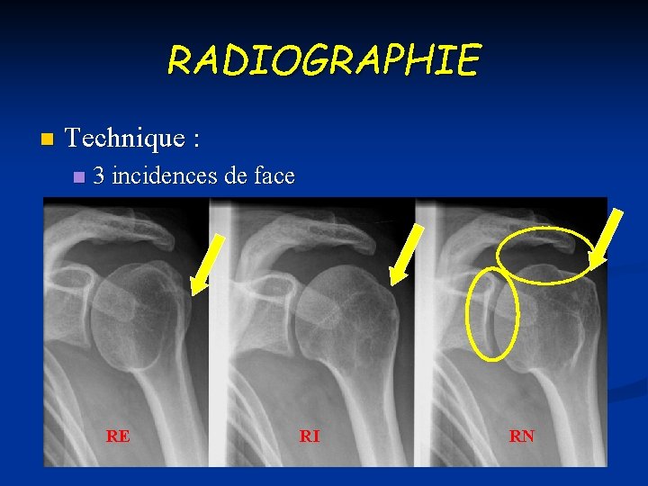 RADIOGRAPHIE n Technique : n 3 incidences de face RE RI RN 