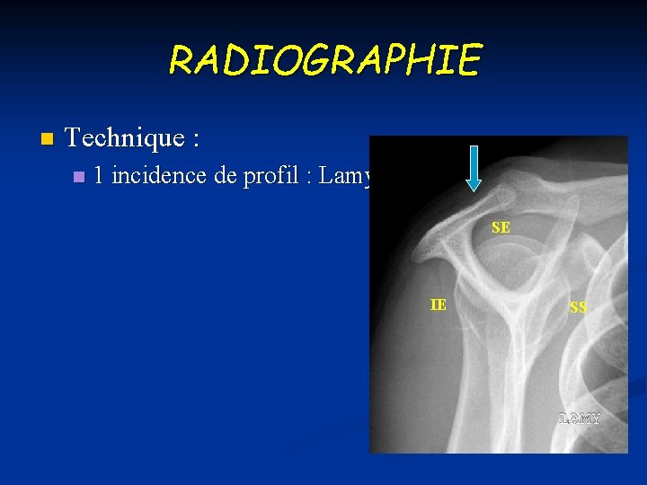 RADIOGRAPHIE n Technique : n 1 incidence de profil : Lamy SE IE SS