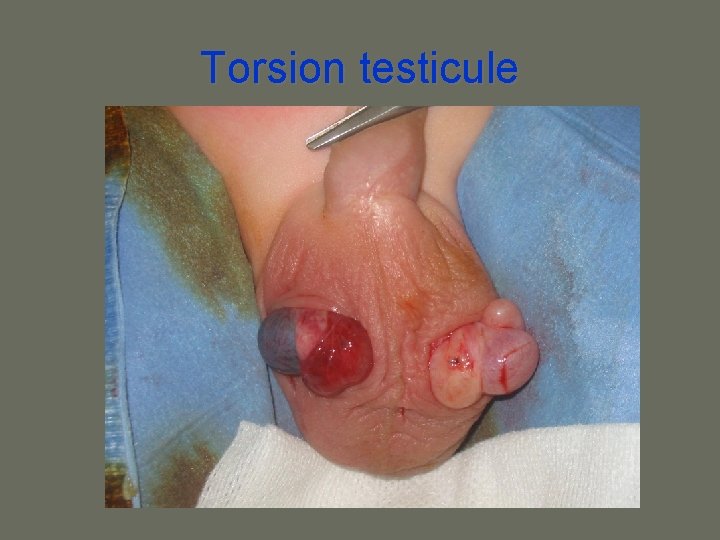 Torsion testicule 