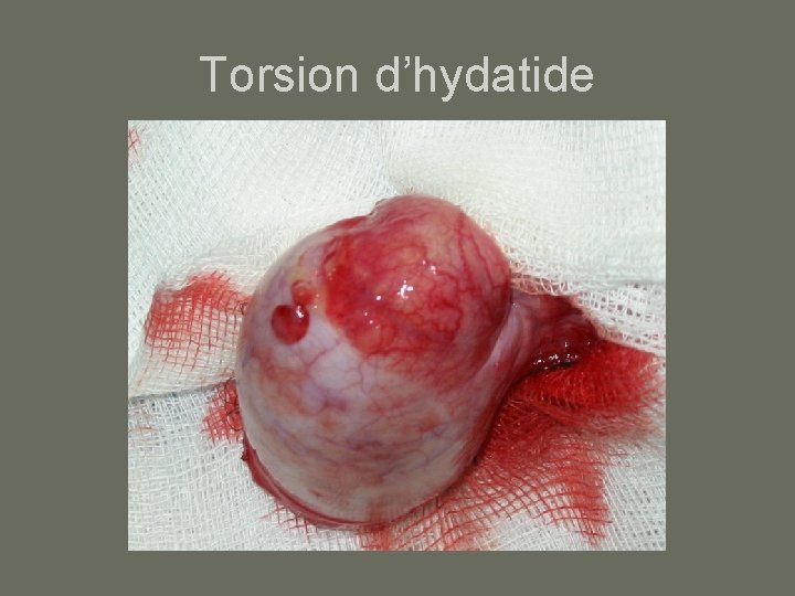 Torsion d’hydatide 