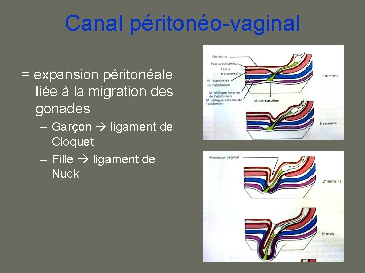 Canal péritonéo-vaginal = expansion péritonéale liée à la migration des gonades – Garçon ligament