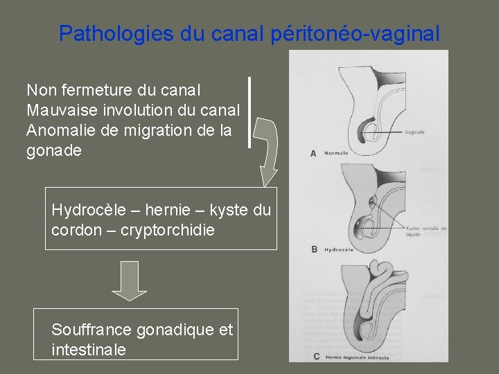 Pathologies du canal péritonéo-vaginal Non fermeture du canal Mauvaise involution du canal Anomalie de