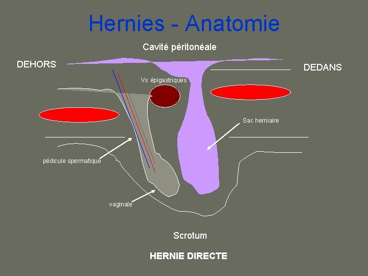 Hernies - Anatomie Cavité péritonéale DEHORS DEDANS Vx épigastriques Sac herniaire pédicule spermatique vaginale