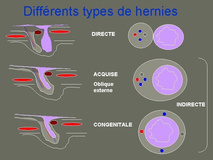 Différents types de hernies DIRECTE ACQUISE Oblique externe INDIRECTE CONGENITALE 