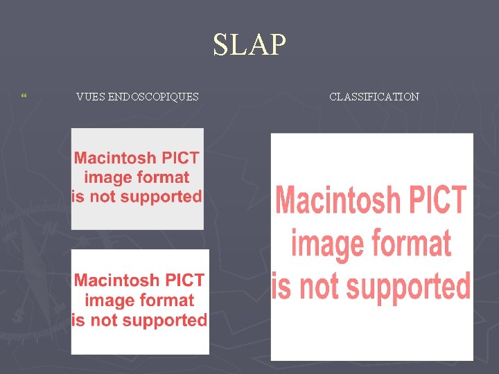 SLAP } VUES ENDOSCOPIQUES CLASSIFICATION 