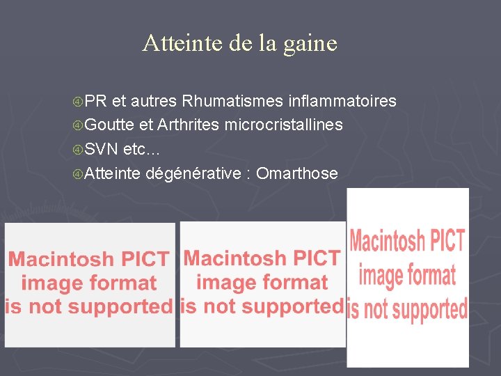 Atteinte de la gaine PR et autres Rhumatismes inflammatoires Goutte et Arthrites microcristallines SVN