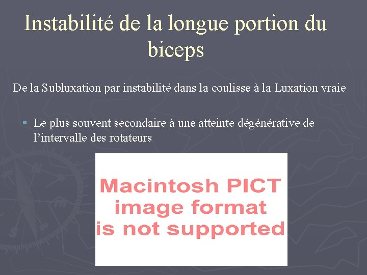Instabilité de la longue portion du biceps De la Subluxation par instabilité dans la