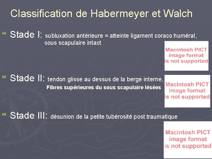 Classification de Habermeyer et Walch } Stade I: subluxation antérieure = atteinte ligament coraco