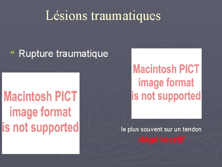 Lésions traumatiques } Rupture traumatique le plus souvent sur un tendon dégénératif 