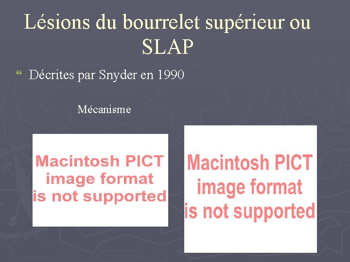 Lésions du bourrelet supérieur ou SLAP } Décrites par Snyder en 1990 Mécanisme 