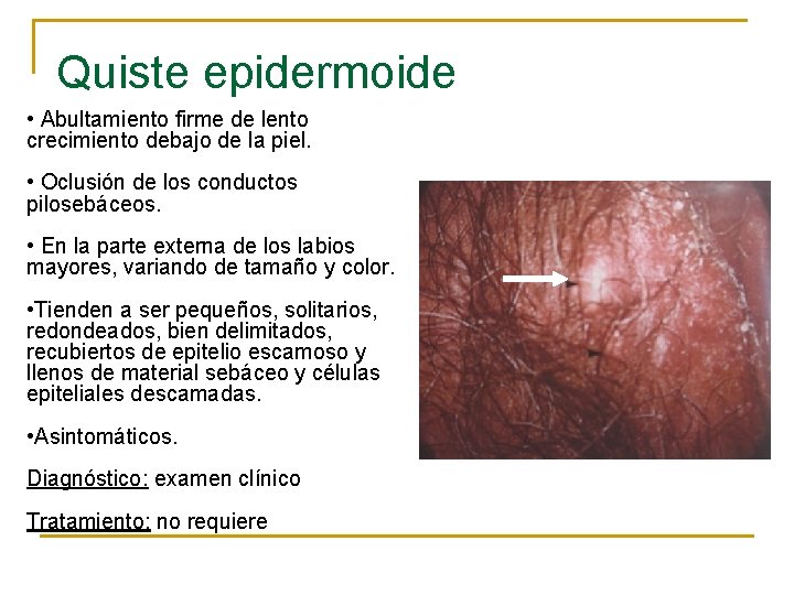Quiste epidermoide • Abultamiento firme de lento crecimiento debajo de la piel. • Oclusión