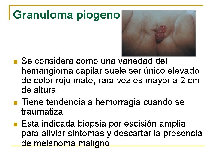 Granuloma piogeno n n n Se considera como una variedad del hemangioma capilar suele