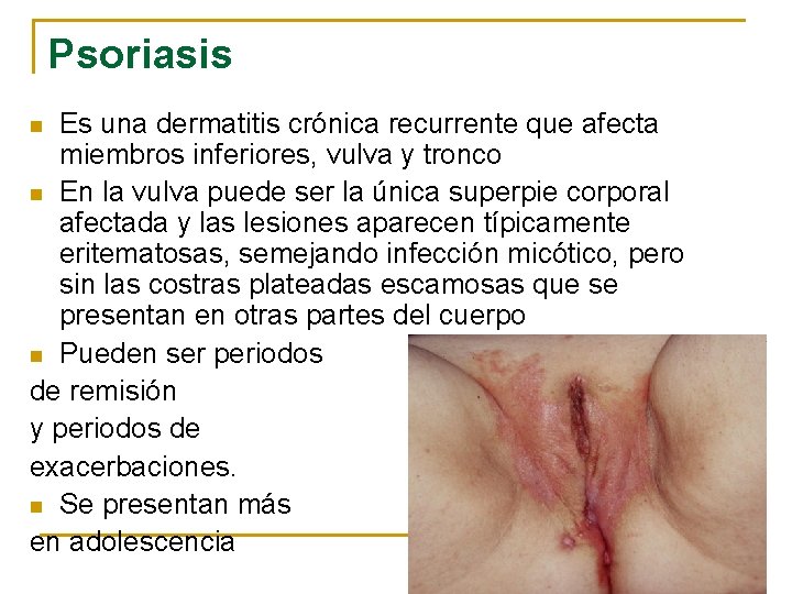Psoriasis Es una dermatitis crónica recurrente que afecta miembros inferiores, vulva y tronco n
