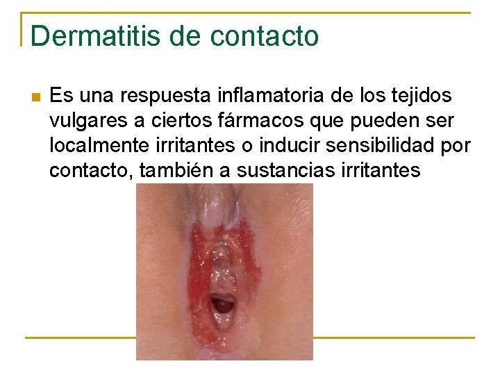 Dermatitis de contacto n Es una respuesta inflamatoria de los tejidos vulgares a ciertos