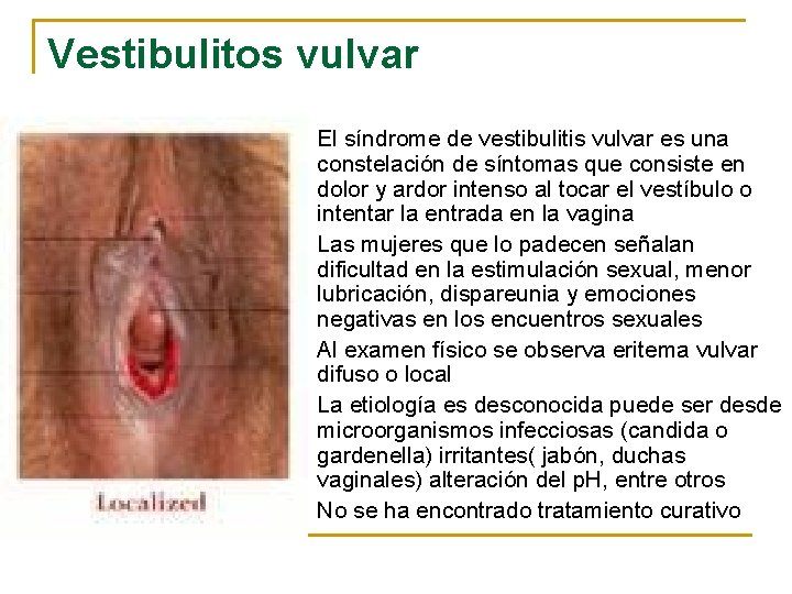 Vestibulitos vulvar n n n El síndrome de vestibulitis vulvar es una constelación de