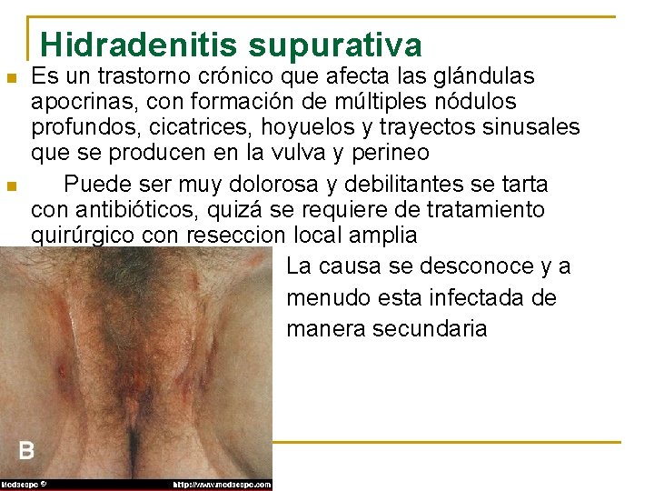 Hidradenitis supurativa n n n Es un trastorno crónico que afecta las glándulas apocrinas,