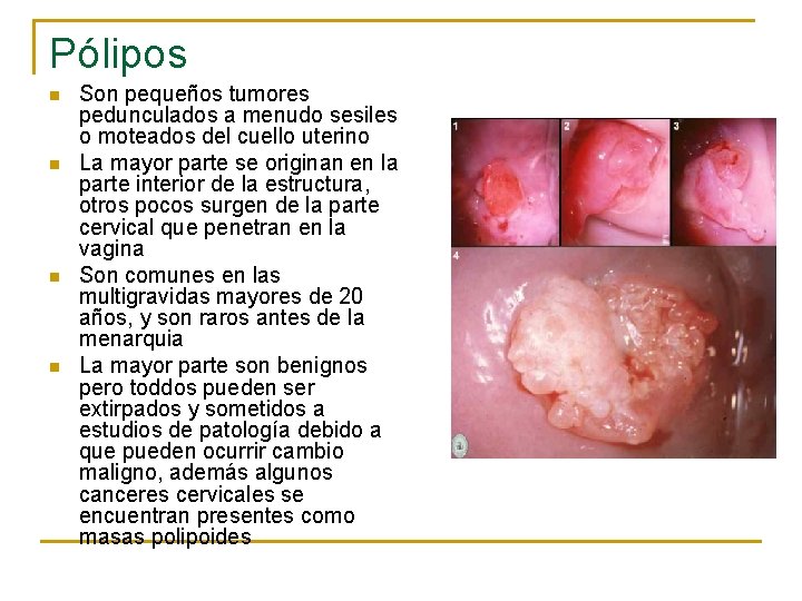 Pólipos n n Son pequeños tumores pedunculados a menudo sesiles o moteados del cuello