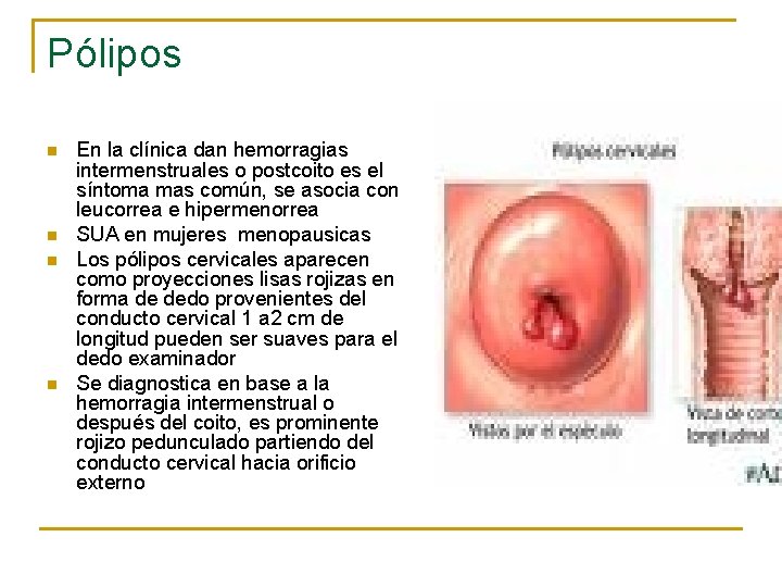 Pólipos n n En la clínica dan hemorragias intermenstruales o postcoito es el síntoma