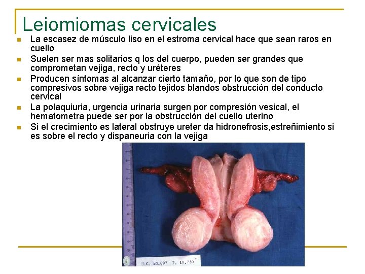 Leiomiomas cervicales n n n La escasez de músculo liso en el estroma cervical