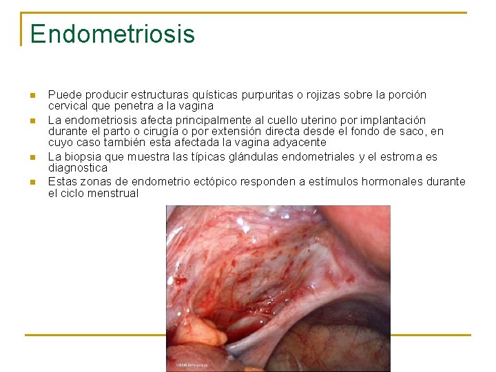 Endometriosis n n Puede producir estructuras quísticas purpuritas o rojizas sobre la porción cervical