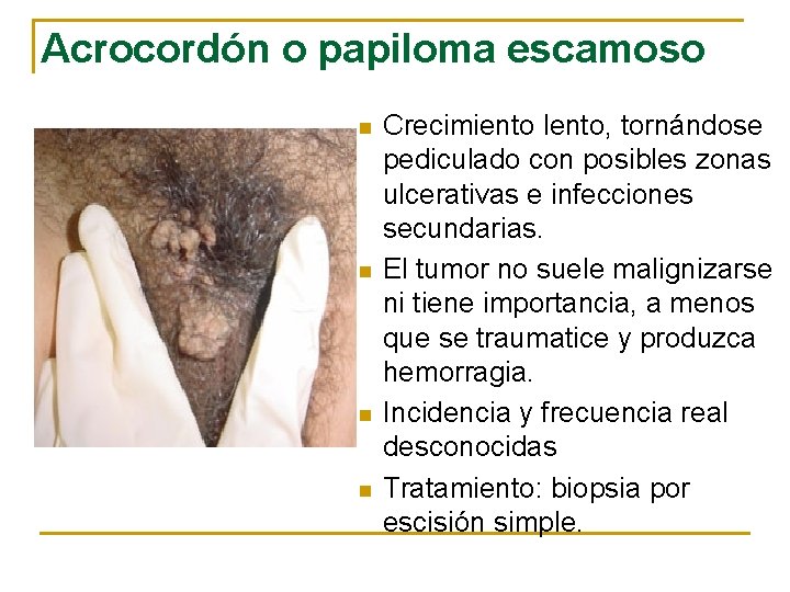 Acrocordón o papiloma escamoso n n Crecimiento lento, tornándose pediculado con posibles zonas ulcerativas