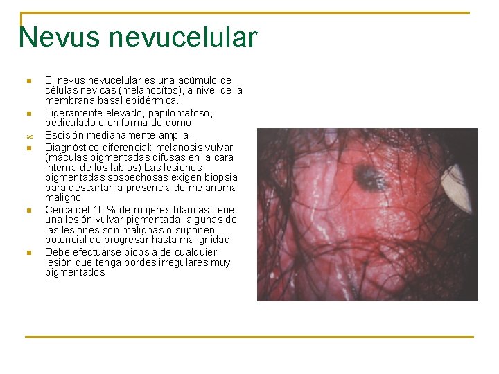 Nevus nevucelular n n n El nevus nevucelular es una acúmulo de células névicas