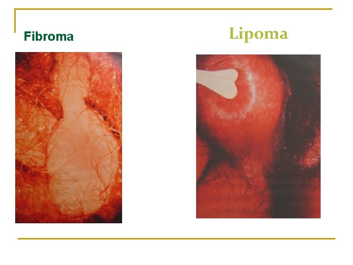 Fibroma Lipoma 