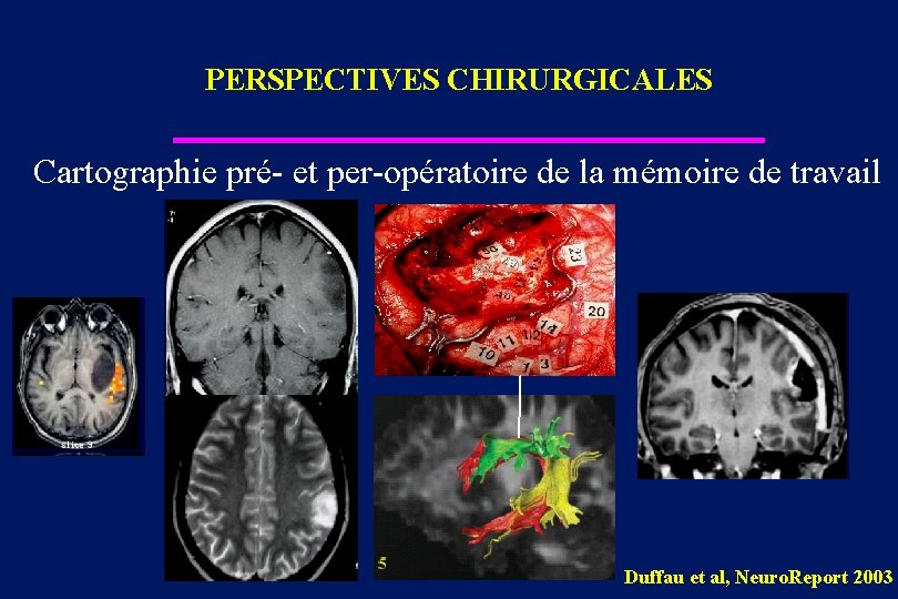 PERSPECTIVES CHIRURGICALES Cartographie pré- et per-opératoire de la mémoire de travail Duffau et al,