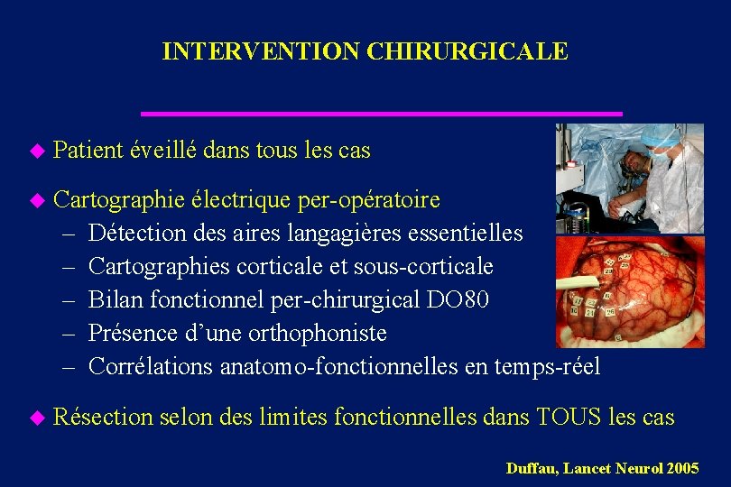 INTERVENTION CHIRURGICALE u Patient éveillé dans tous les cas u Cartographie électrique per-opératoire –