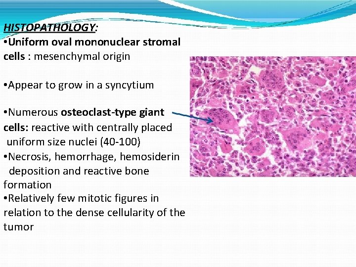 HISTOPATHOLOGY: • Uniform oval mononuclear stromal cells : mesenchymal origin • Appear to grow