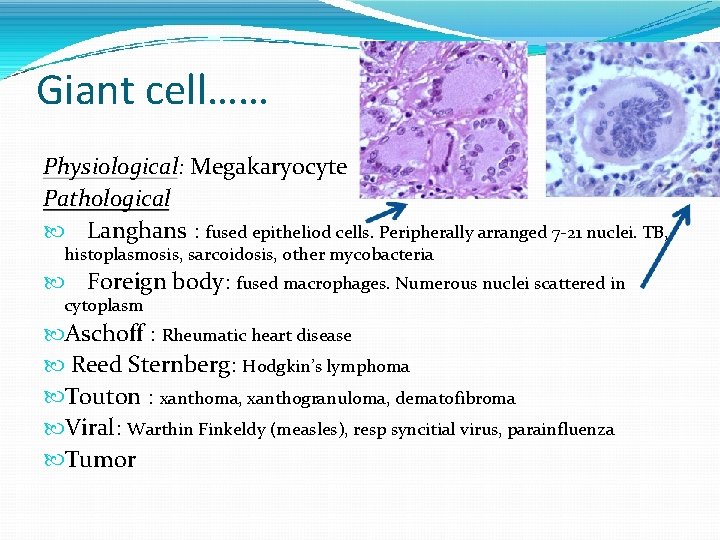 Giant cell…… Physiological: Megakaryocyte Pathological Langhans : fused epitheliod cells. Peripherally arranged 7 -21