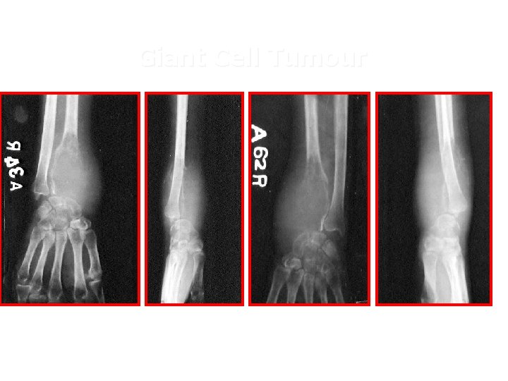 Giant Cell Tumour 