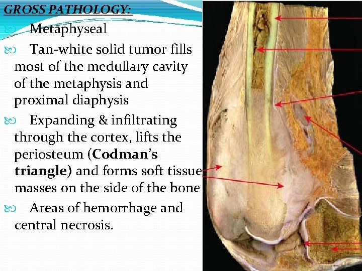 GROSS PATHOLOGY: Metaphyseal Tan-white solid tumor fills most of the medullary cavity of the