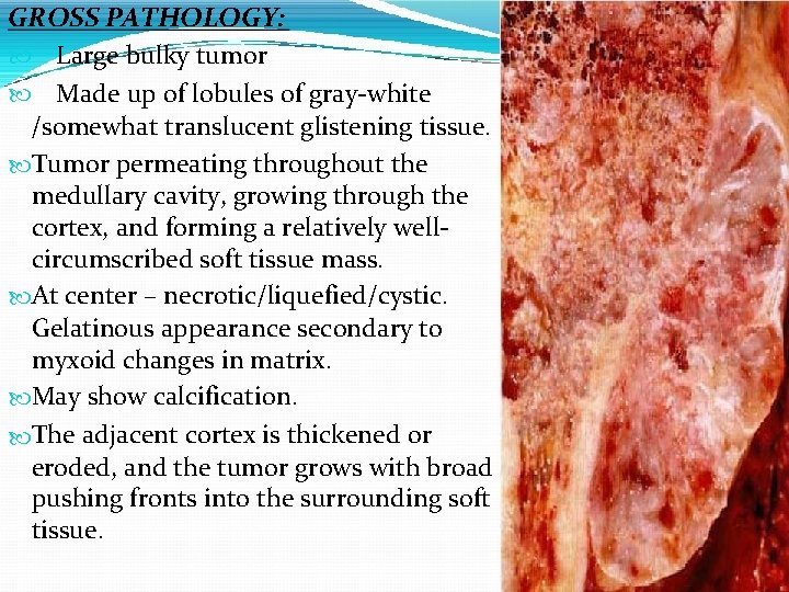 GROSS PATHOLOGY: Large bulky tumor Made up of lobules of gray-white /somewhat translucent glistening