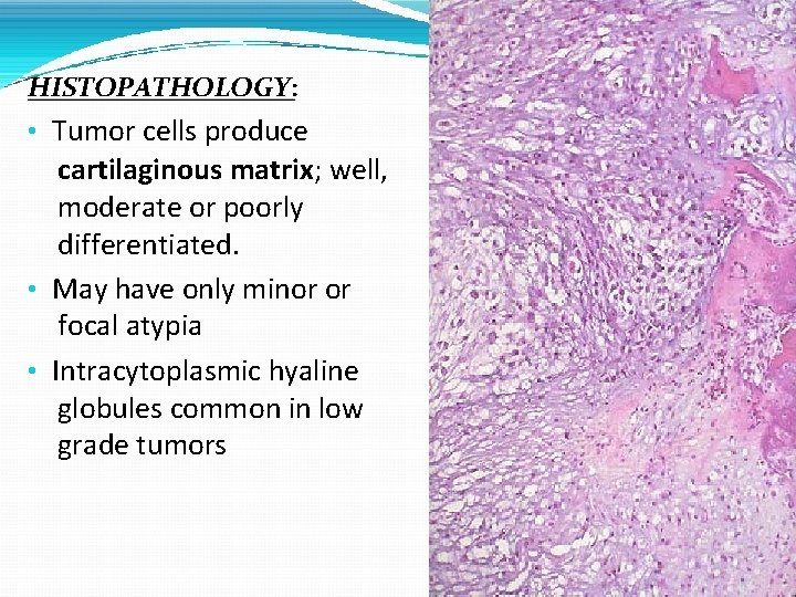 HISTOPATHOLOGY: • Tumor cells produce cartilaginous matrix; well, moderate or poorly differentiated. • May