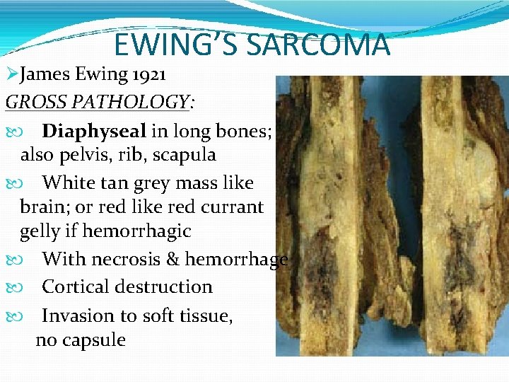 EWING’S SARCOMA James Ewing 1921 GROSS PATHOLOGY: Diaphyseal in long bones; also pelvis, rib,