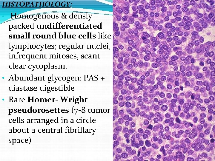 HISTOPATHOLOGY: Homogenous & densly packed undifferentiated small round blue cells like lymphocytes; regular nuclei,