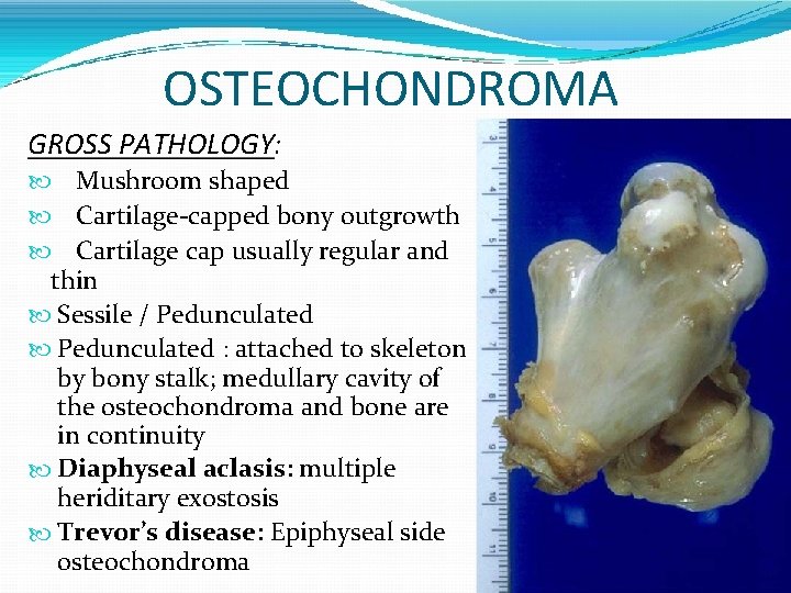 OSTEOCHONDROMA GROSS PATHOLOGY: Mushroom shaped Cartilage-capped bony outgrowth Cartilage cap usually regular and thin