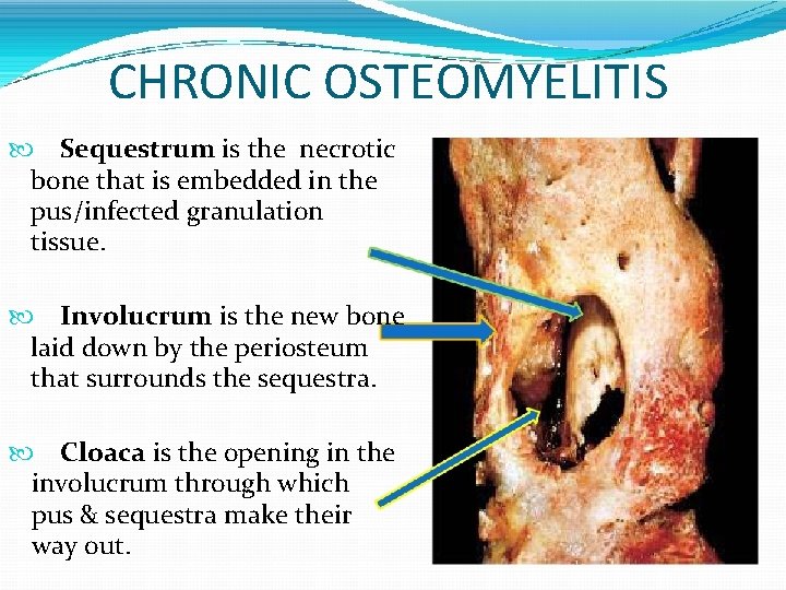 CHRONIC OSTEOMYELITIS Sequestrum is the necrotic bone that is embedded in the pus/infected granulation